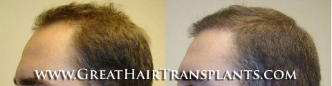 low cost hair transplant