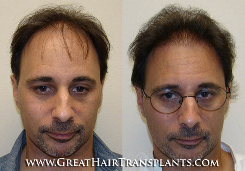 hair transplants