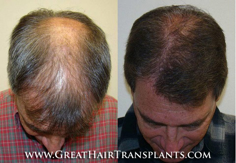 hair procedures