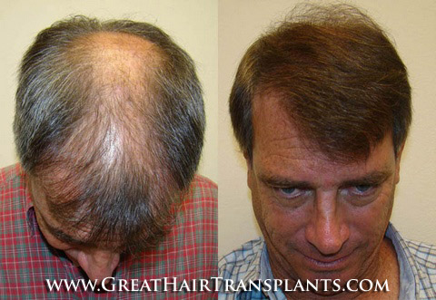 hair transplant