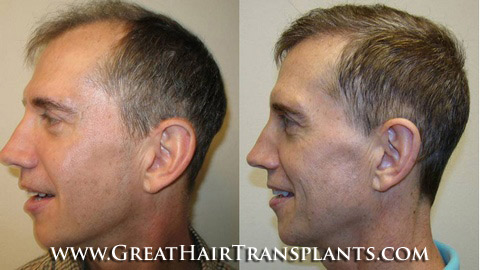 how much does a hair transplant cost