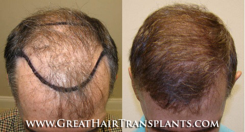 hair implant