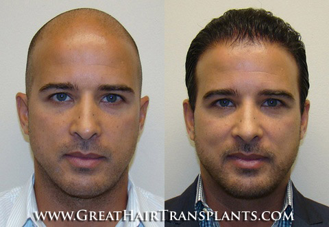 hair transplant cost