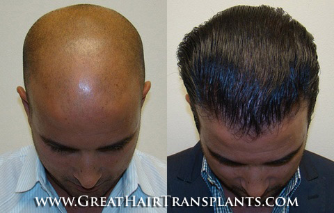 hair loss treatments