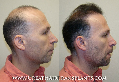 hair transplant