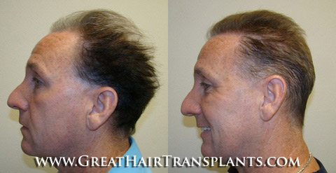 hair implant