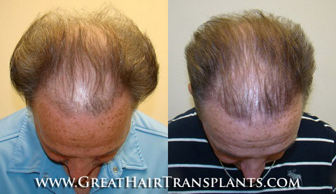 hair transplants