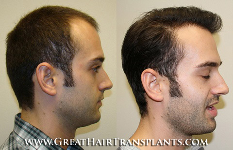 hair transplant