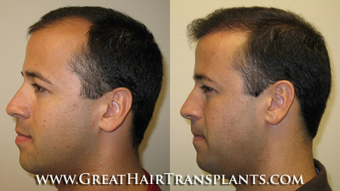 hair implant